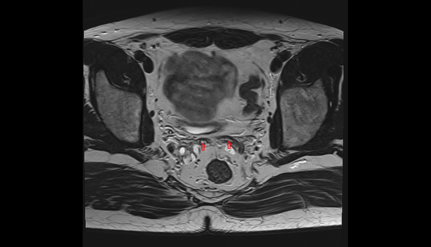 Ampulla of vas deferens  MRI axial  image-img-00000-00000