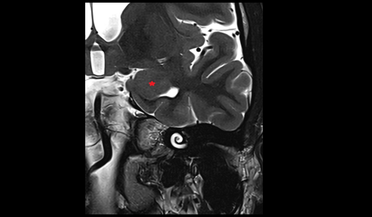 Amygdala mri 3t coronal image
