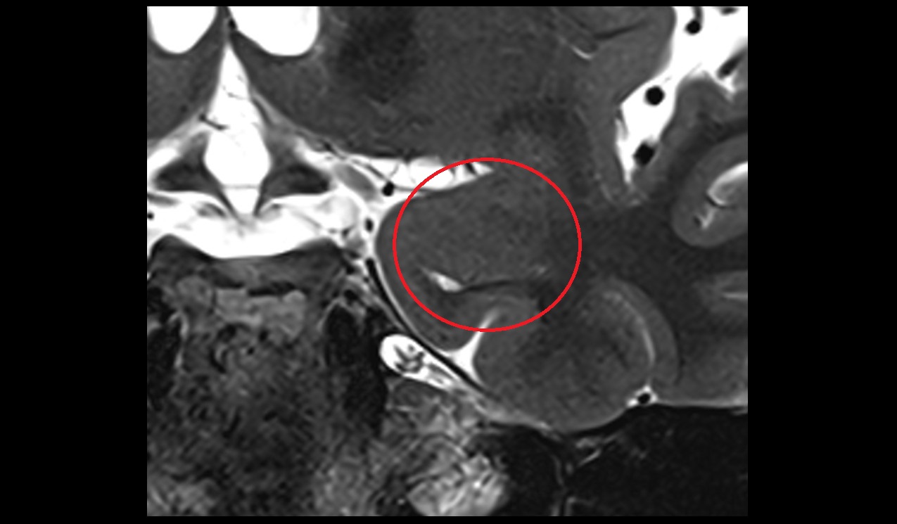 Amygdalohippocampal area mri 3t coronal image
