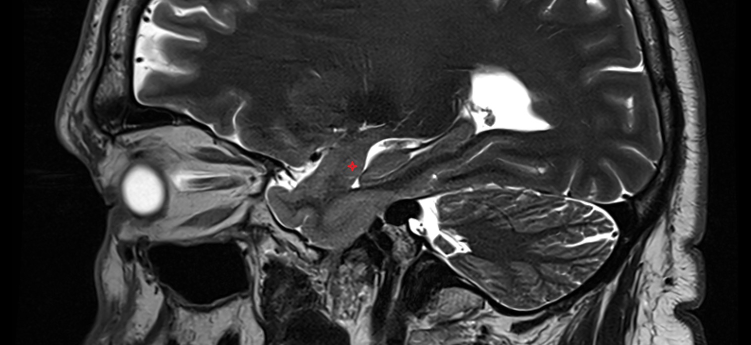 Amygdaloid body MRI sagittal cross sectional anatomy radiology image