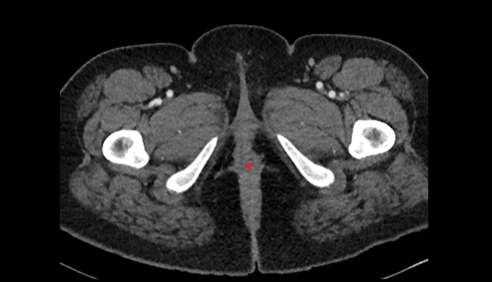 Anal canal ct axial anatomy  image