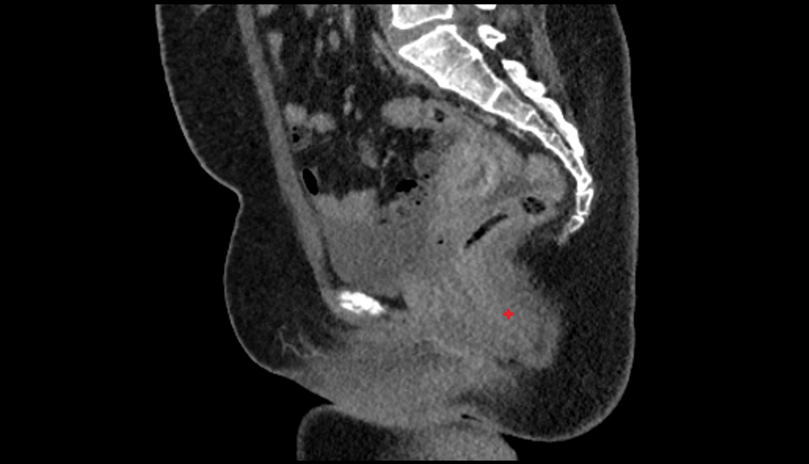 Anal canal ct sagittal  anatomy  image