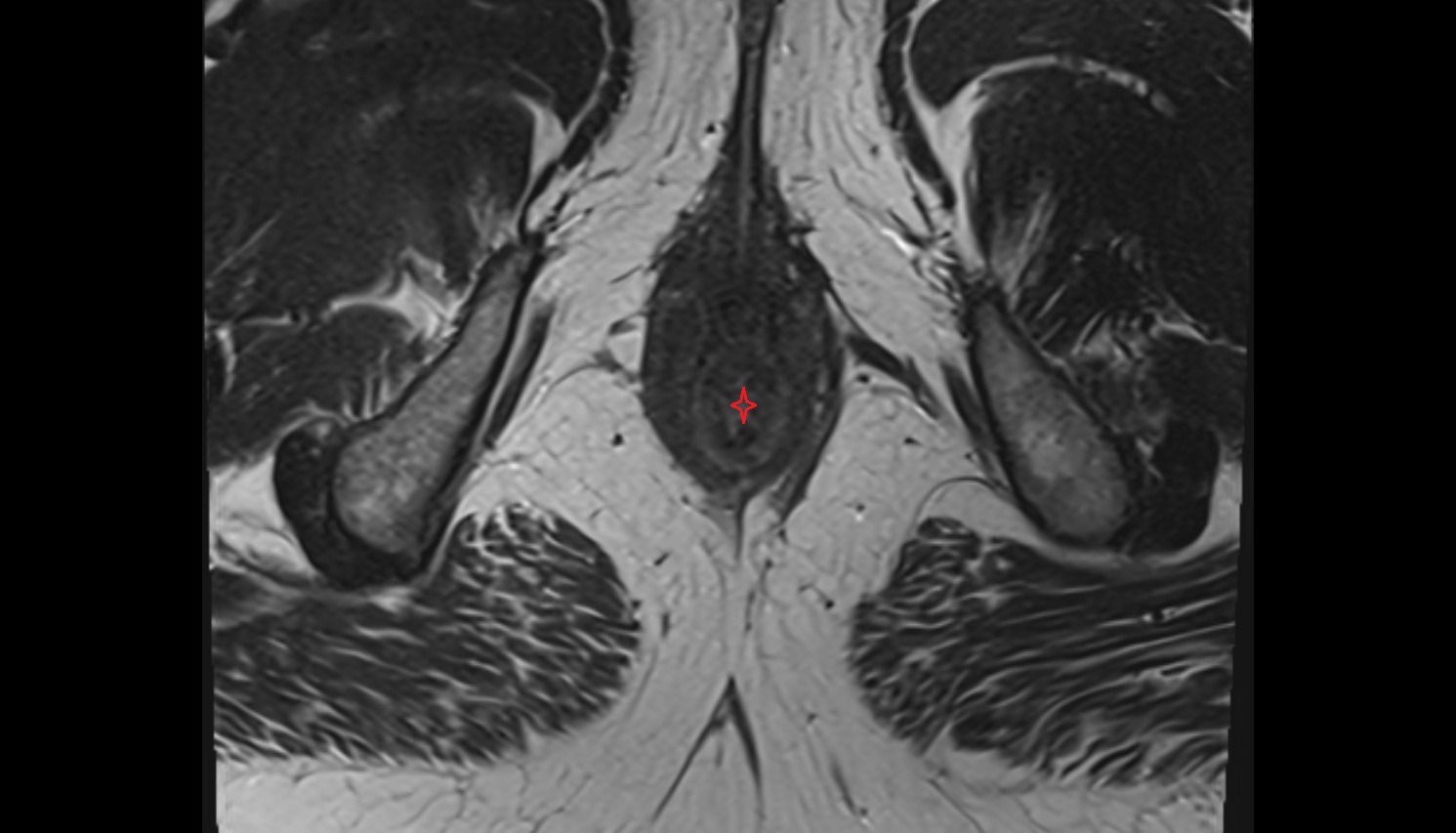 Anal canal mri axial anatomy  image-img-00000-00000