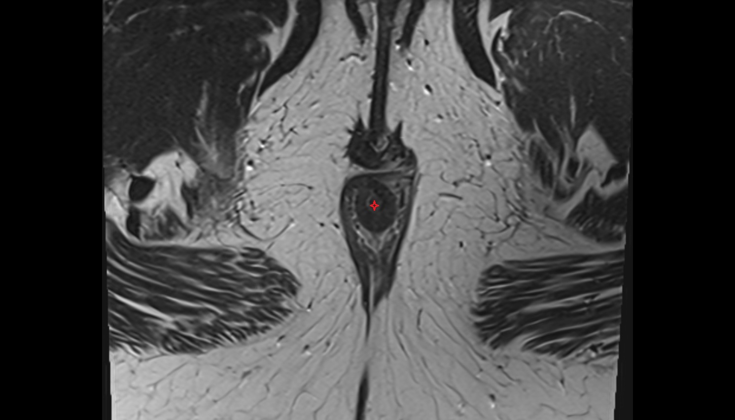 Anal canal mri axial anatomy  image-img-00000-00000_00001