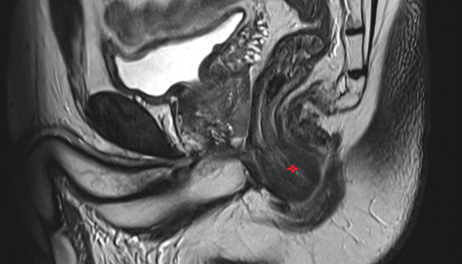 Anal canal mri sagittal  anatomy  image-img-00000-00000