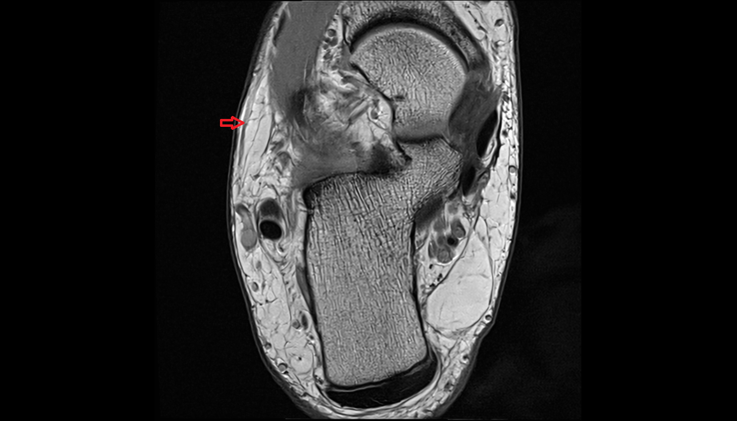 Anastomotic branch of sural nerve to medial cutaneous nerve axial  cross sectional anatomy 3T MRI AI enhanced radiology image-img-00000-00000_00001