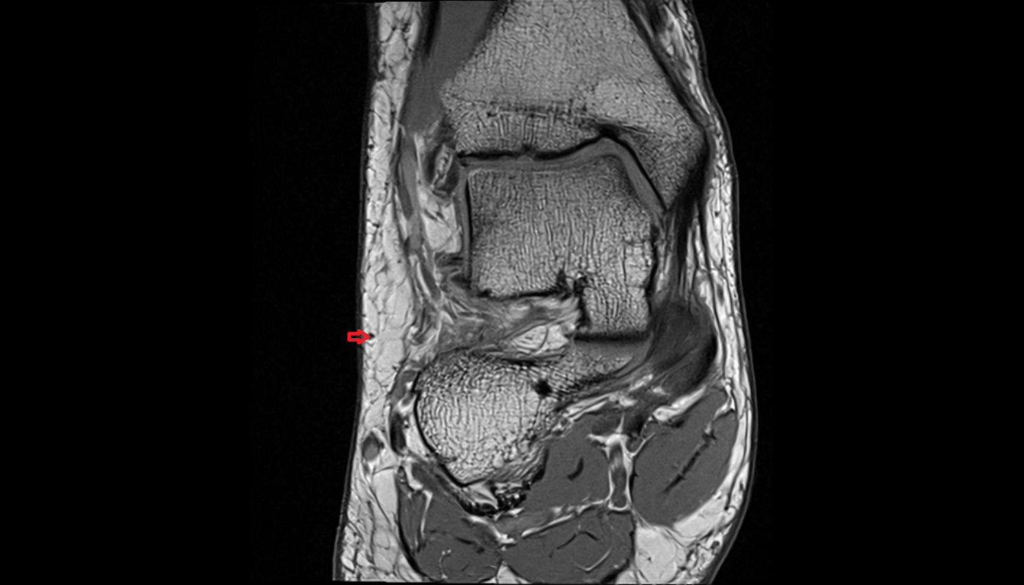 Anastomotic branch of sural nerve to medial cutaneous nerve coronal  cross sectional anatomy 3T MRI AI enhanced radiology image-img-00000-00000