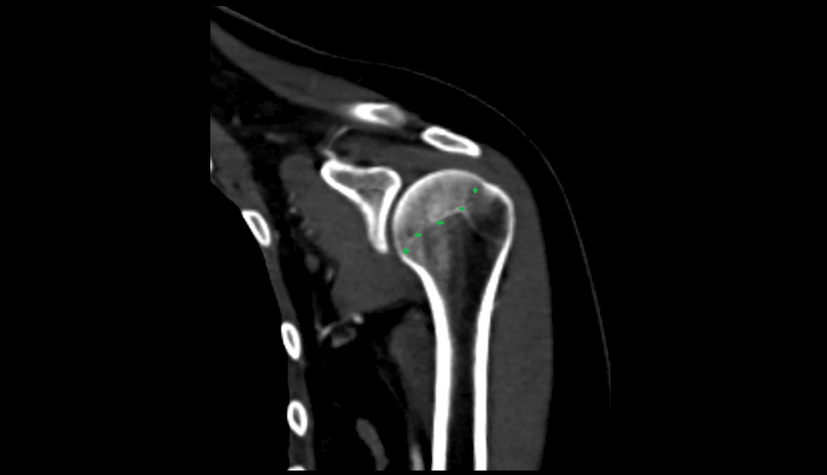 Anatomical neck of humerus ct coronal image