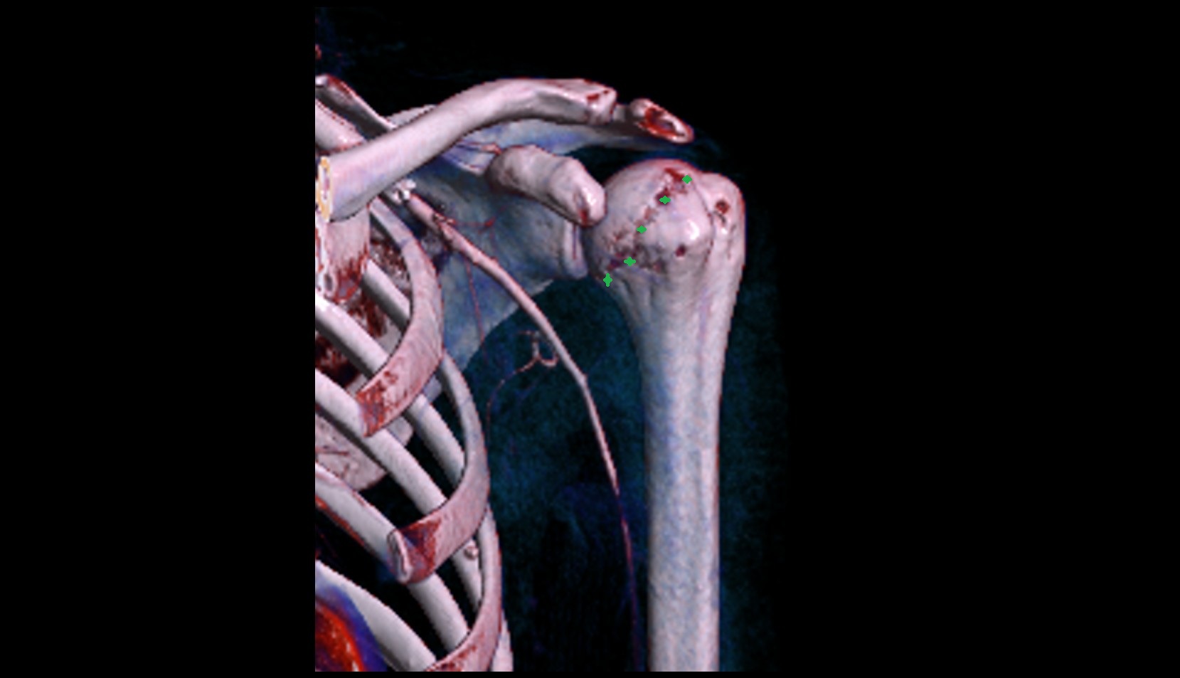 Anatomical neck of humerus ct vrt image