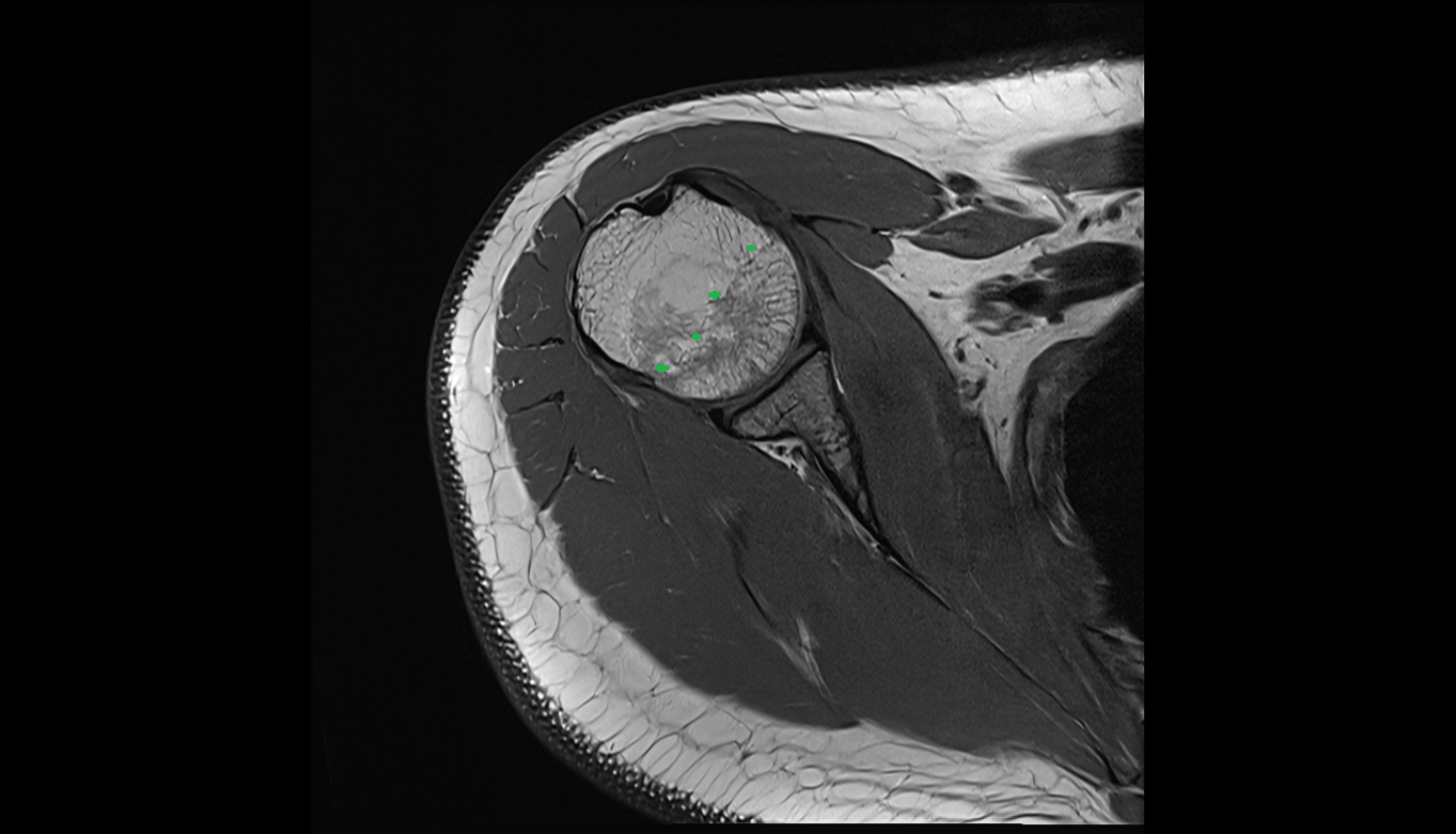 Anatomical neck of humerus  sag cross sectional anatomy 3T MRI AI enhanced radiology image-img-00000-00000