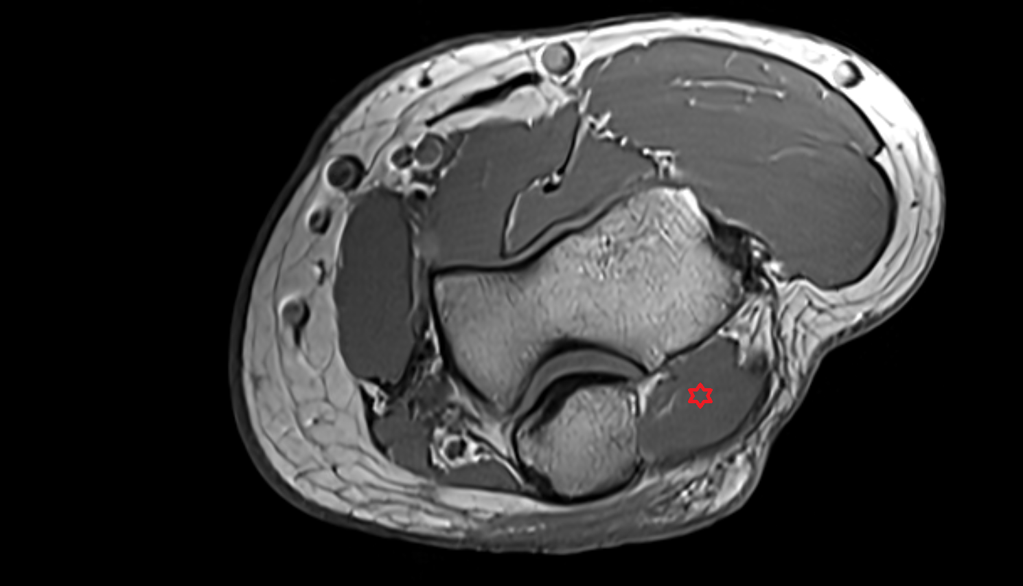 Anconeus muscle  axial cross sectional anatomy 3T MRI AI enhanced radiology image -img-00000-00000
