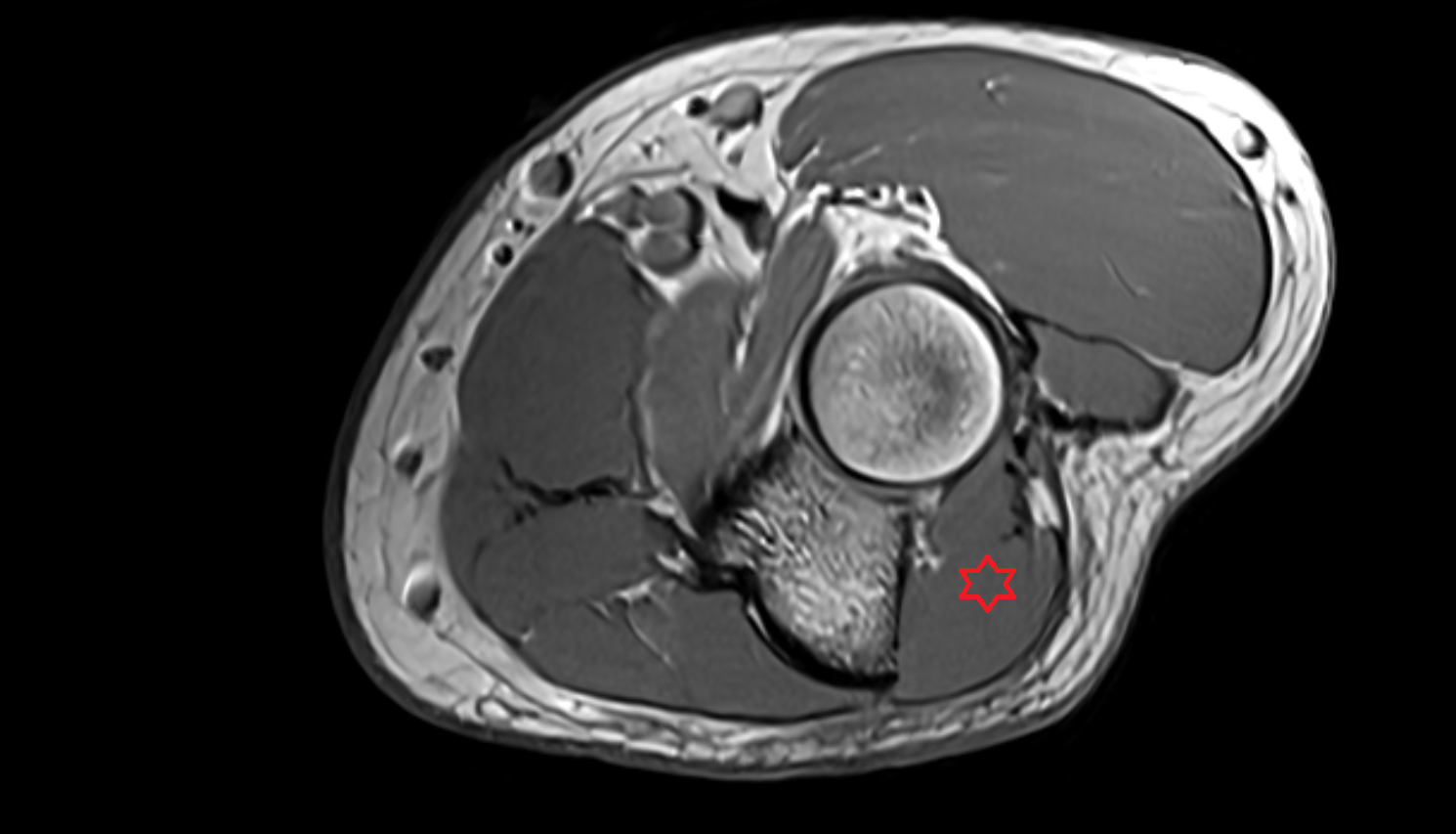 Anconeus muscle  axial cross sectional anatomy 3T MRI AI enhanced radiology image -img-00000-00000_00001