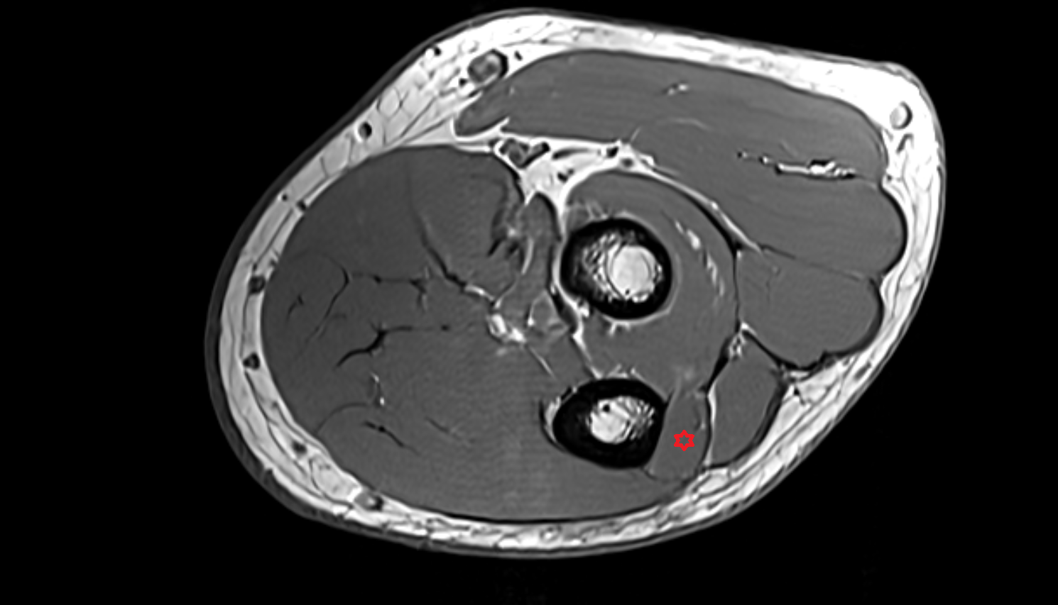 Anconeus muscle  axial cross sectional anatomy 3T MRI AI enhanced radiology image -img-00000-00000_00002