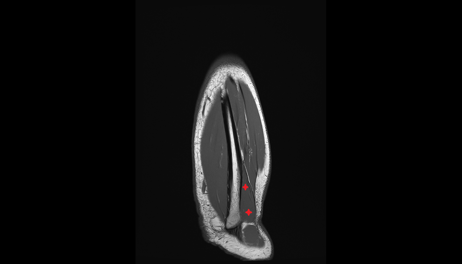 Anconeus muscle  coronal cross sectional anatomy 3T MRI AI enhanced radiology image -img-00000-00000