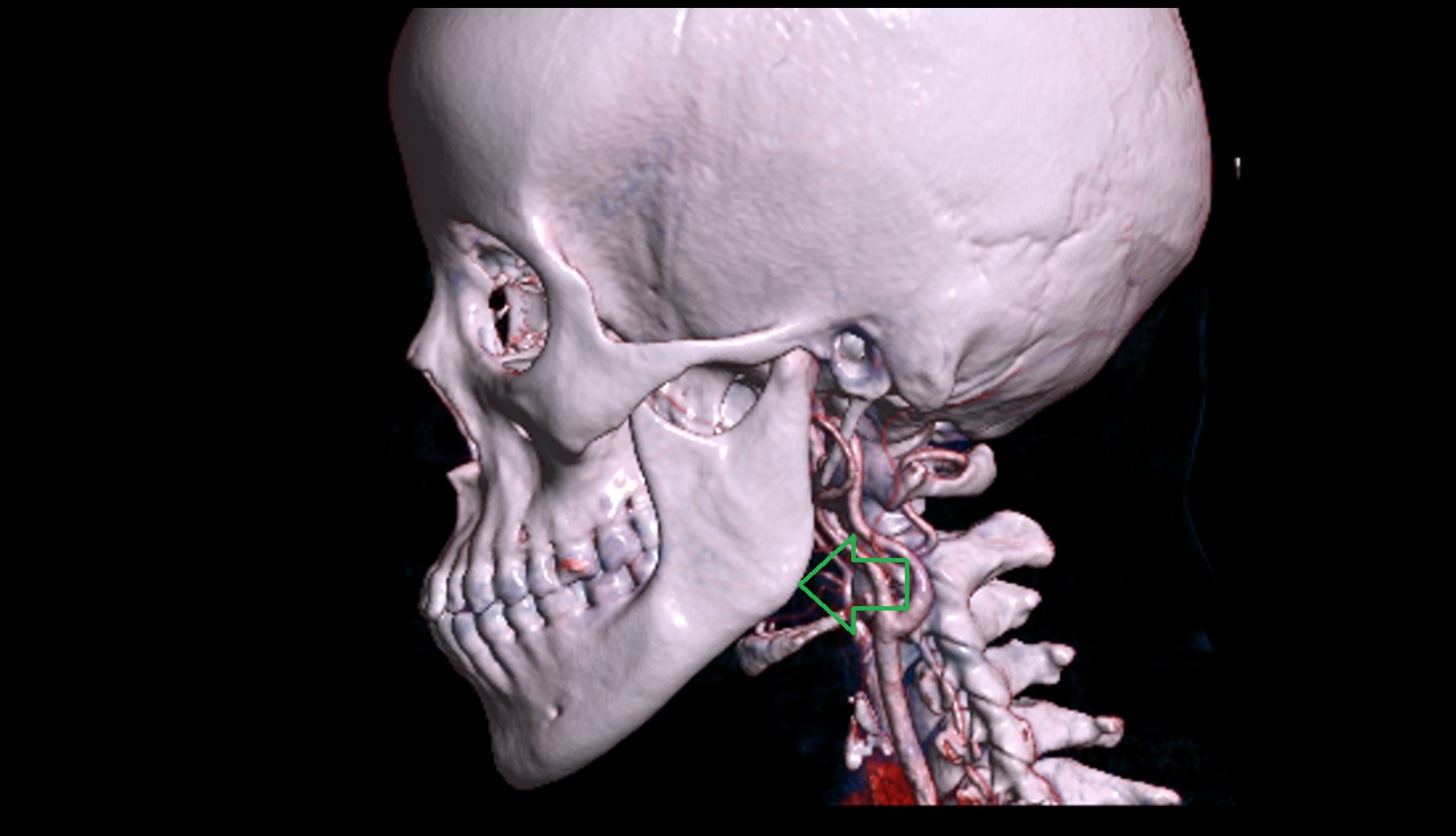 Angle of mandible 3D