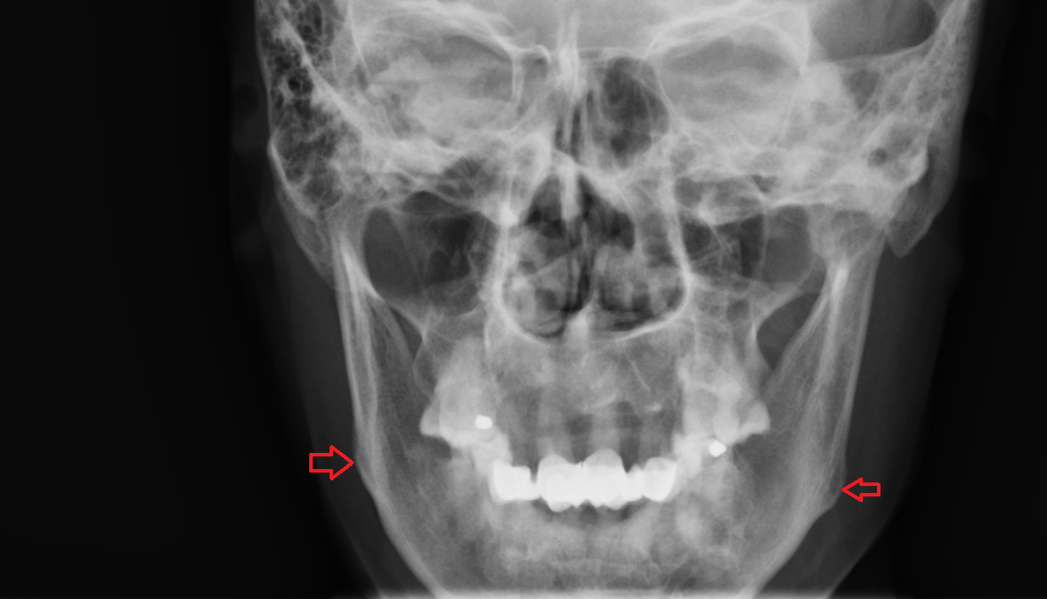 Angle of mandible X RAY  anatomy image -img-00000-00000
