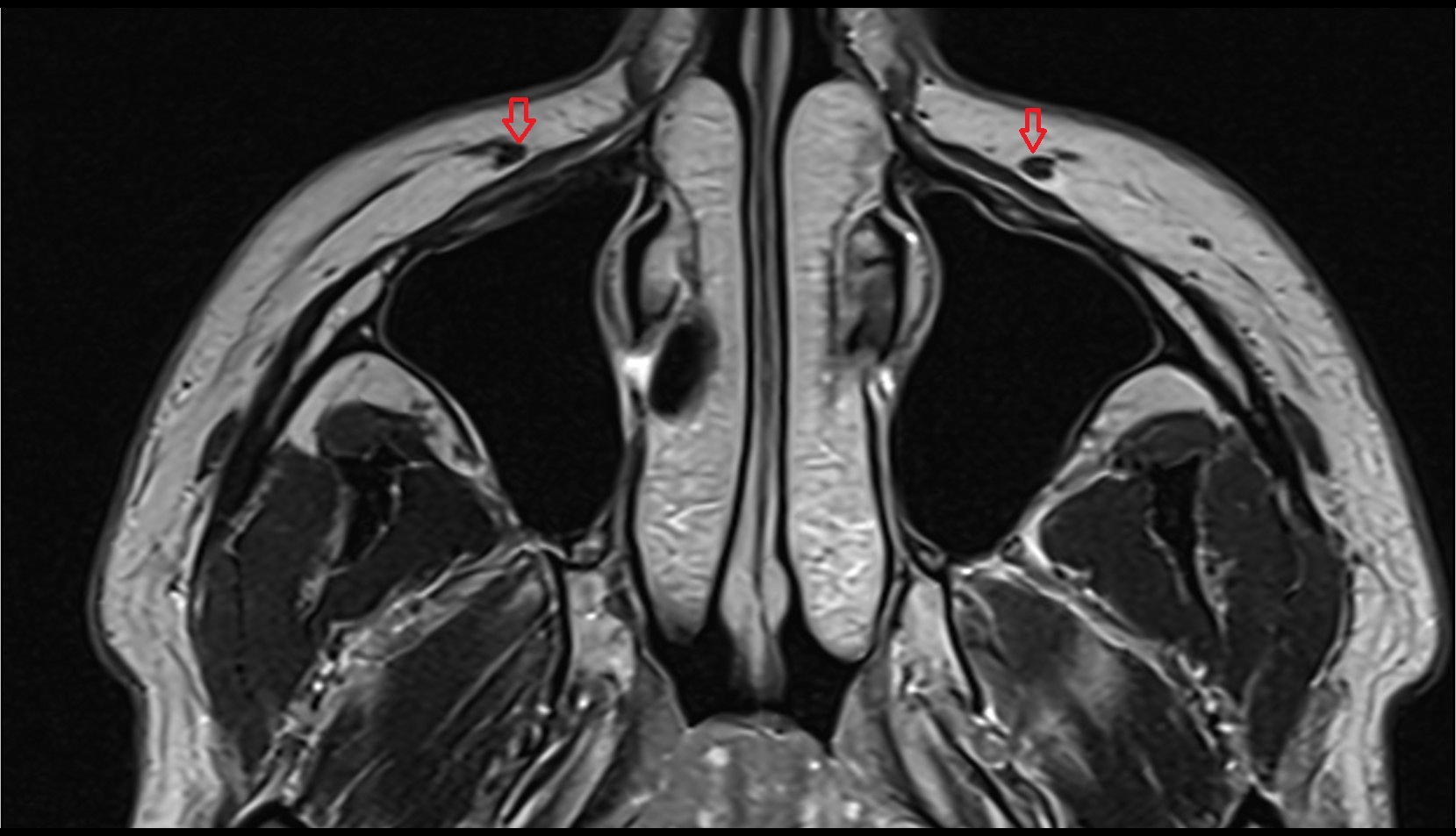 Angular Vein mri axial image