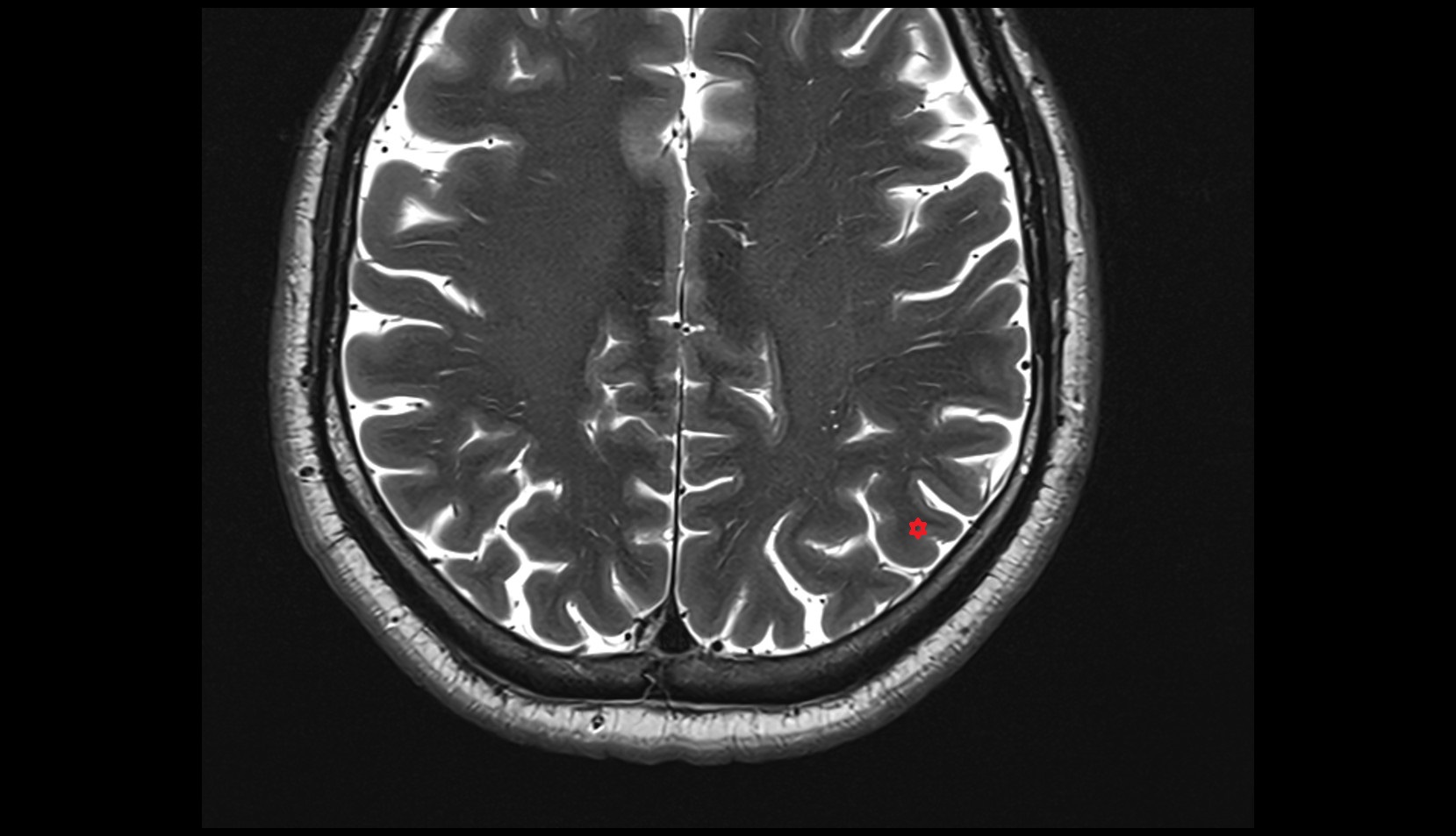 Angular gyrus mri 3t  image