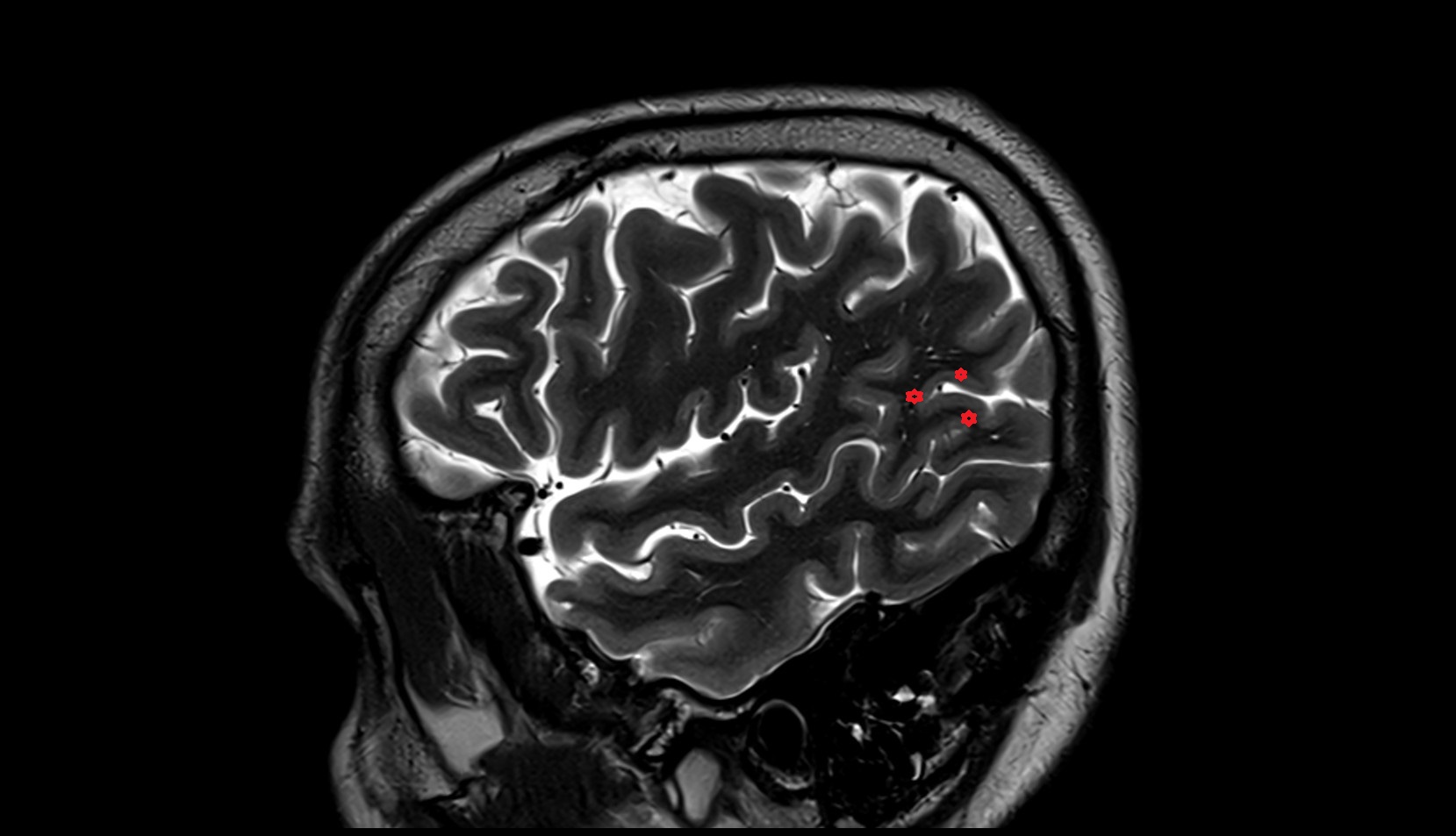 Angular gyrus mri 3t sagittal image