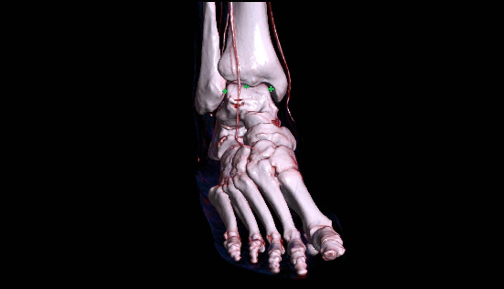 Ankle joint 3d vrt image