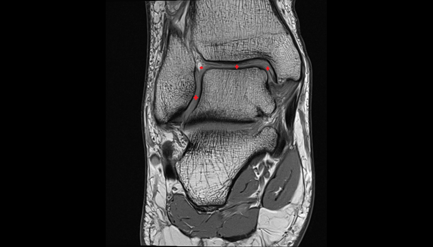 Ankle joint  MRI coronal  cross sectional anatomy 3T MRI AI enhanced radiology image-img-00000-00000