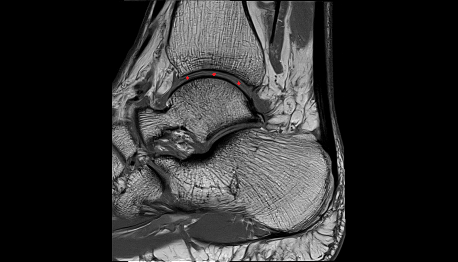 Ankle joint  MRI sagittal  cross sectional anatomy 3T MRI AI enhanced radiology image-img-00000-00000