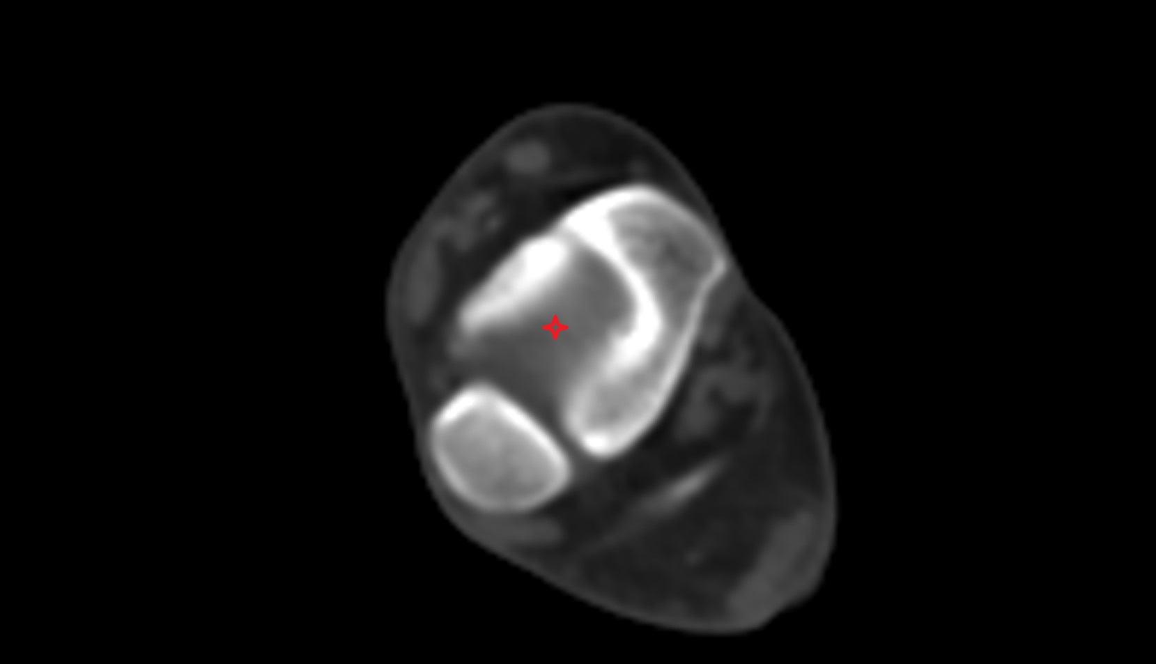 Ankle joint ct axial