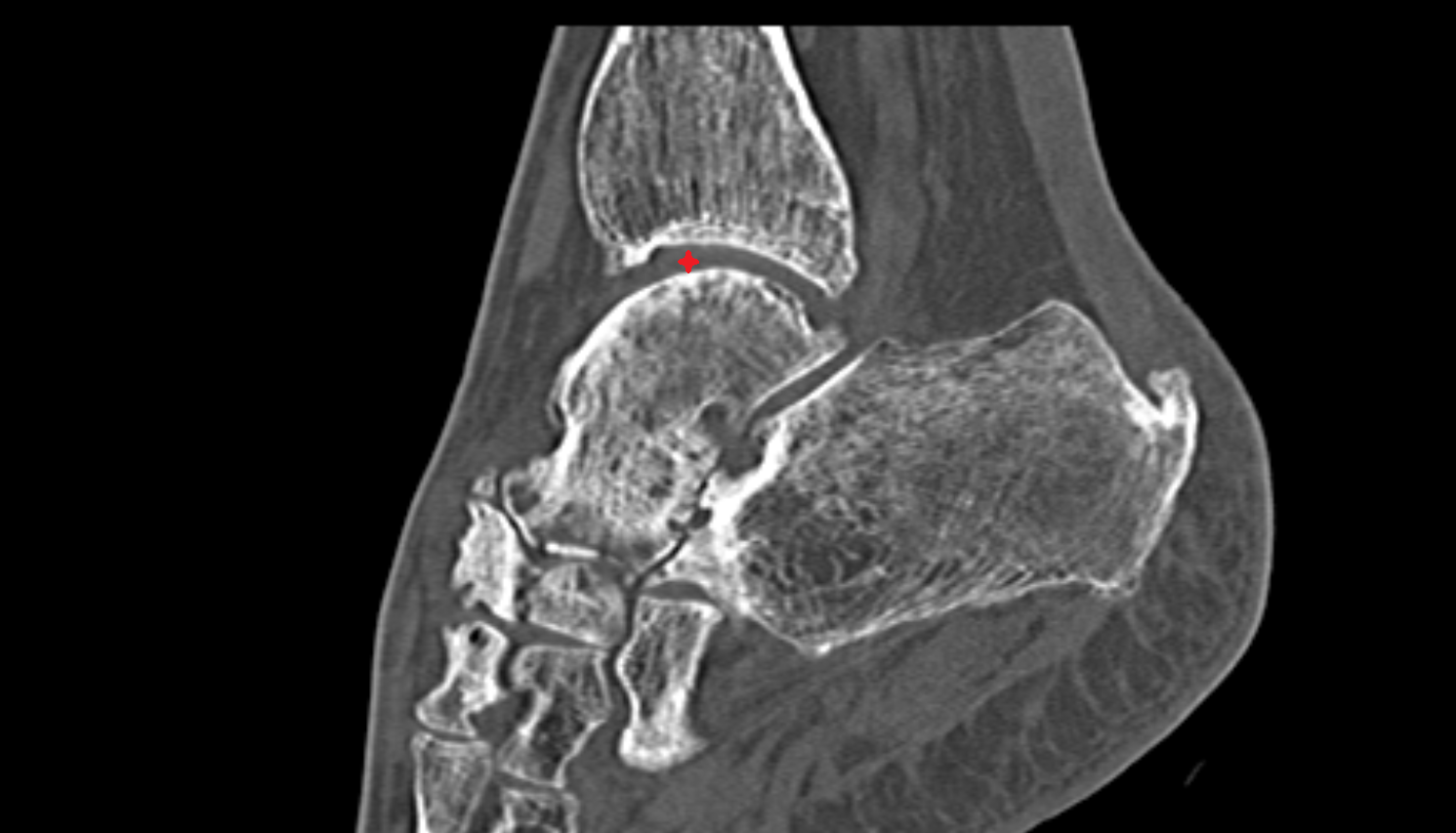 Ankle joint sagittal  CT cross sectional anatomy radiology image-img-00000-00000