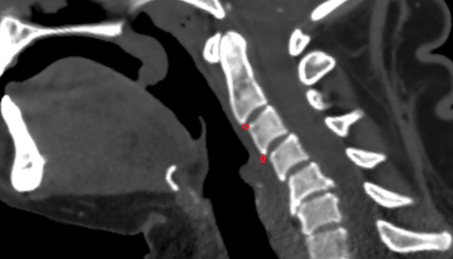 Annular epiphysis ct anatomy  Location and Imaging Appearance  -img-00000-00000