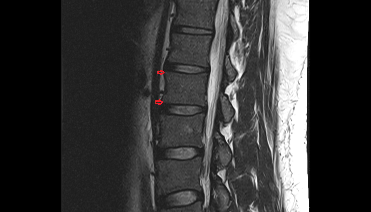 Annular epiphysis mri anatomy  Location and Imaging Appearance  -img-00000-00000