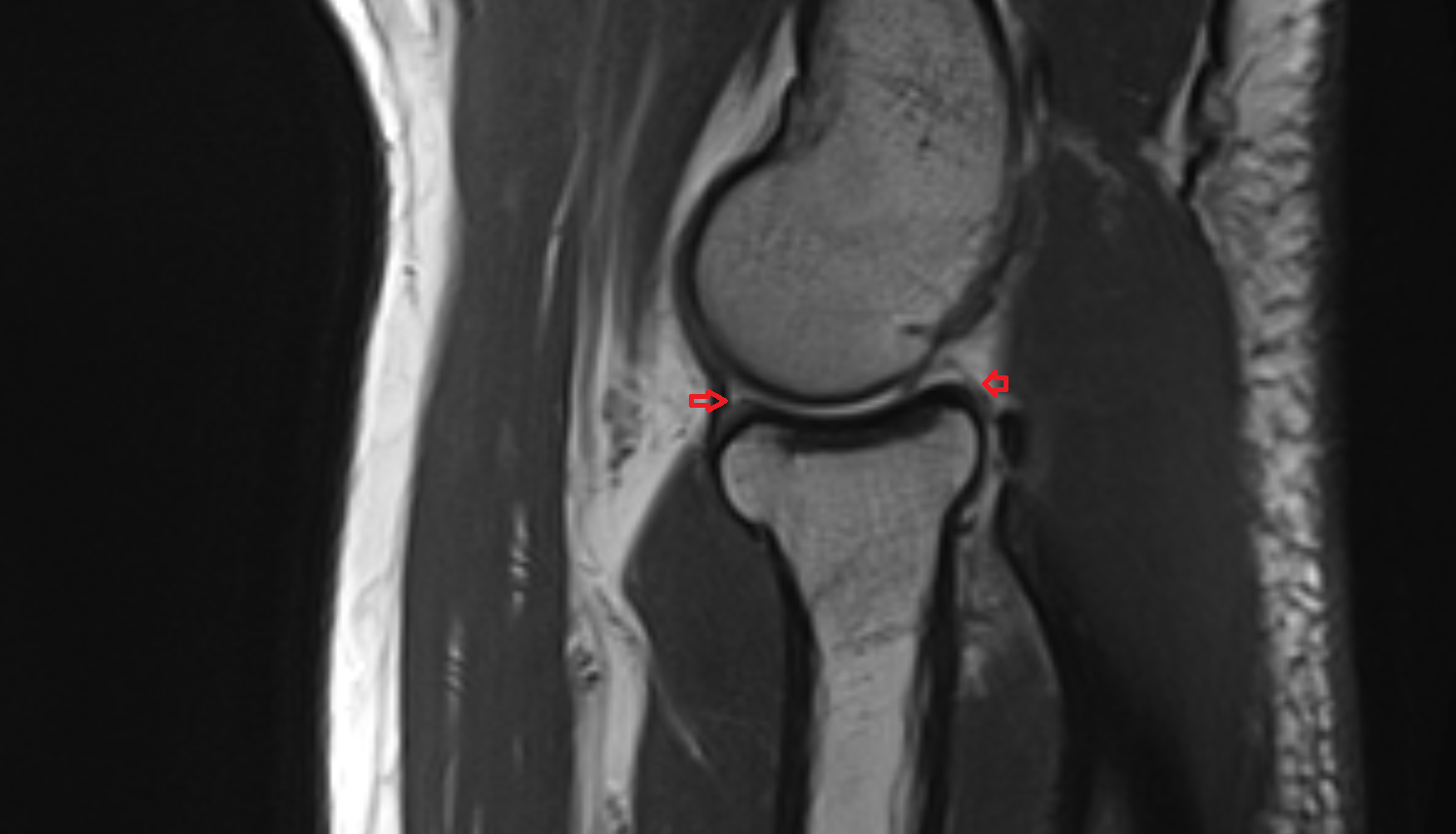 Annular ligament of radius SAG cross sectional anatomy 3T MRI AI enhanced radiology image -img-00000-00000