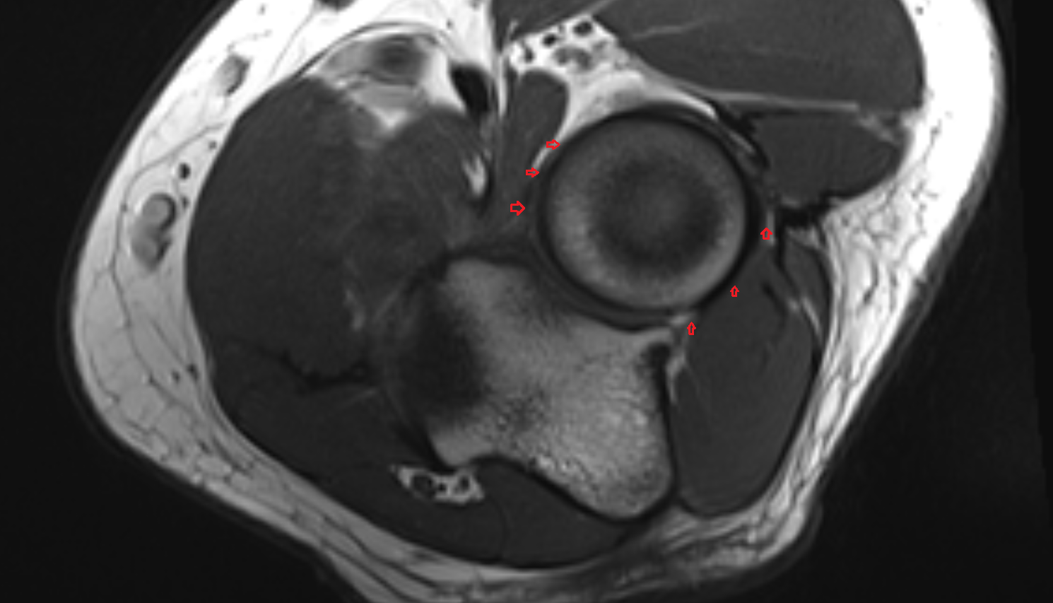 Annular ligament of radius axial cross sectional anatomy 3T MRI AI enhanced radiology image -img-00000-00000