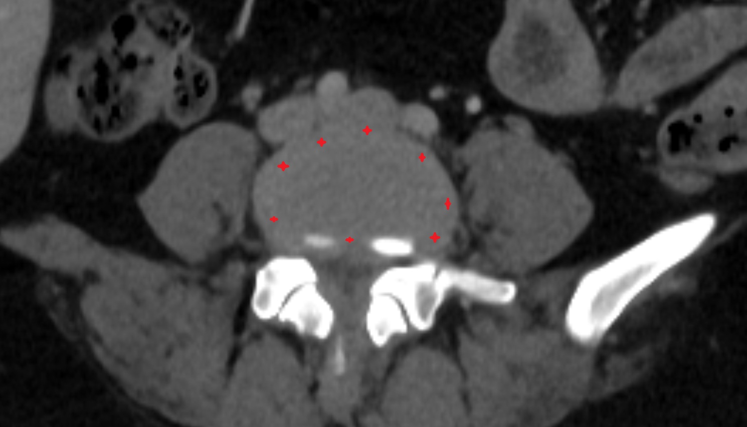 Annulus fibrosus of intervertebral disc  CT axial anatomy  image-img-00000-00000