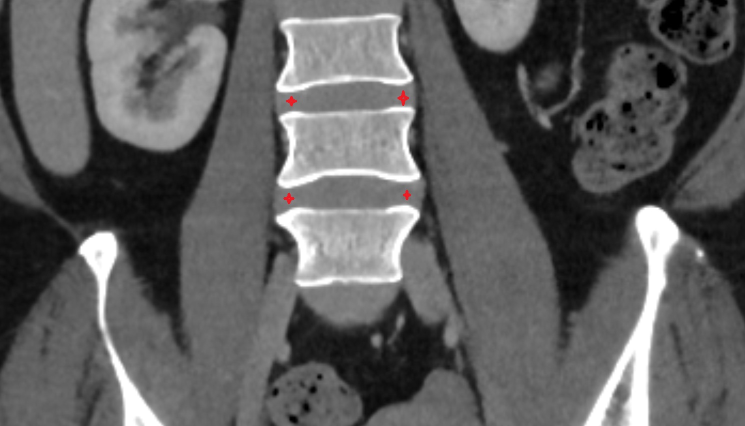 Annulus fibrosus of intervertebral disc  CT coronal anatomy  image-img-00000-00000