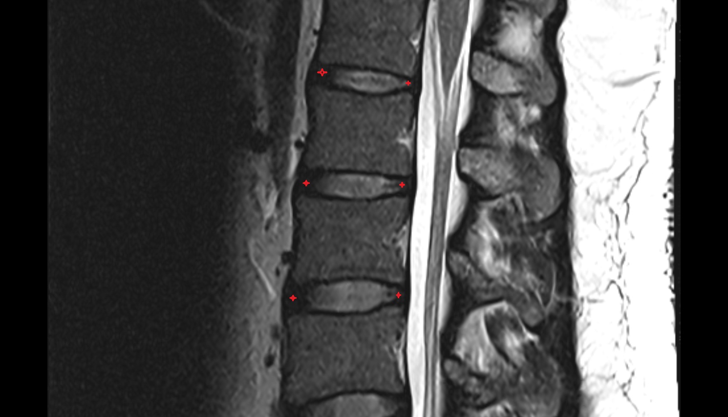 Annulus fibrosus of intervertebral disc   MRI  SAGITTAL anatomy  image-img-00000-00000