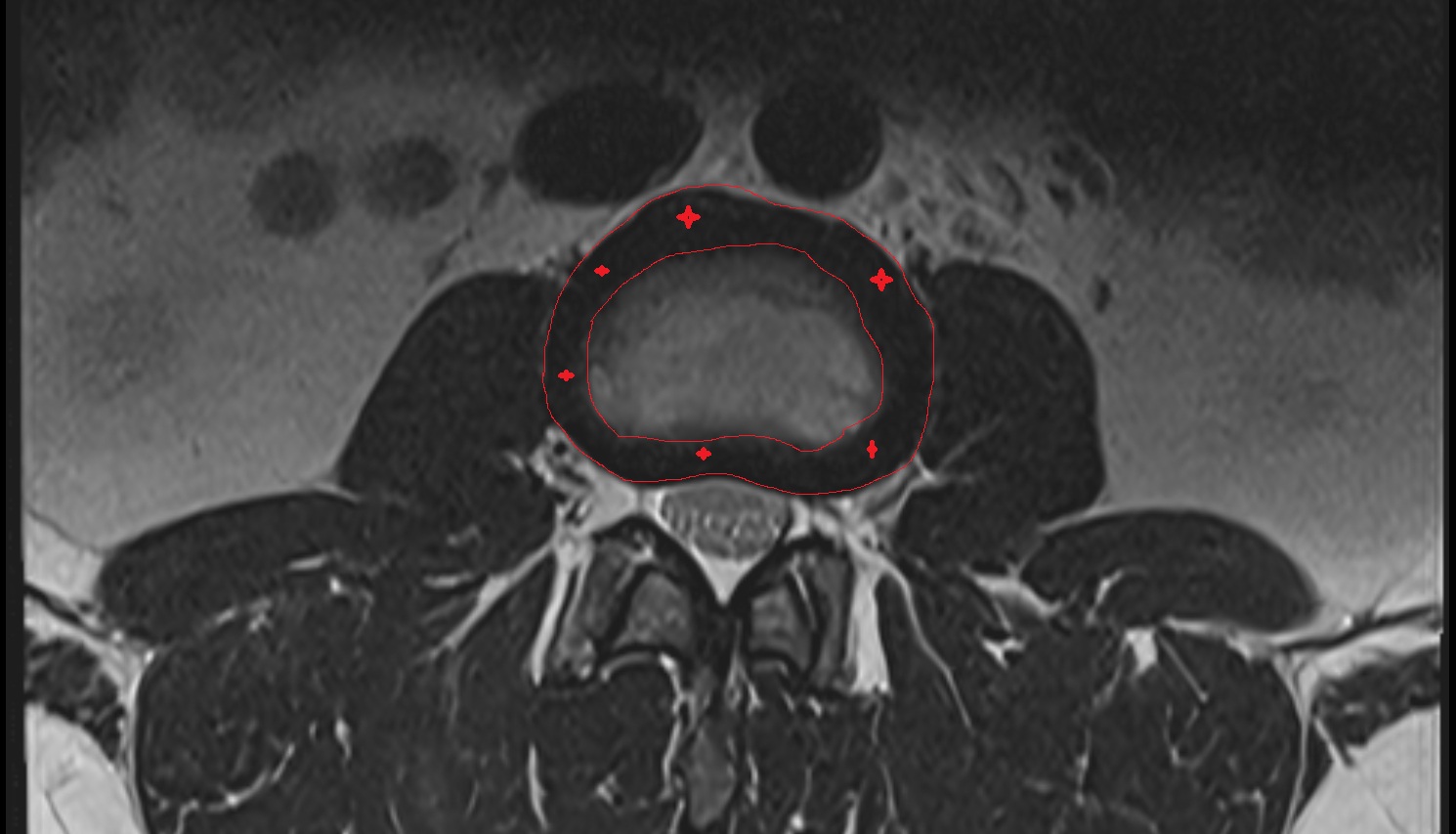 Annulus fibrosus of intervertebral disc   MRI axial  anatomy  image-img-00000-00000_00001