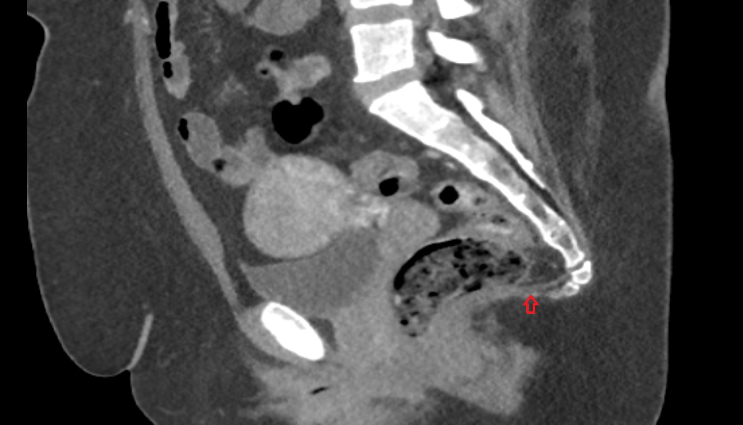Anococcygeal body (anococcygeal ligament)  CT SAG anatomy  image-img-00000-00000