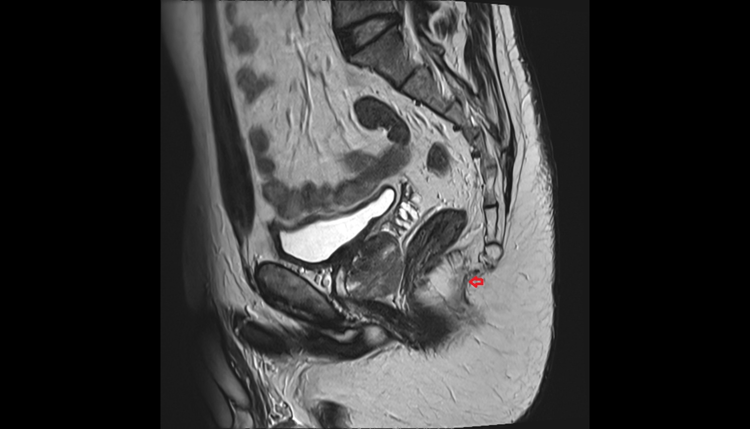 Anococcygeal body (anococcygeal ligament)  CT SAG anatomy  image-img-00000-00000_00001
