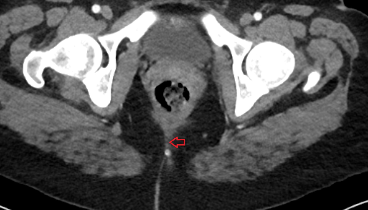 Anococcygeal body (anococcygeal ligament)  CT axial anatomy  image-img-00000-00000