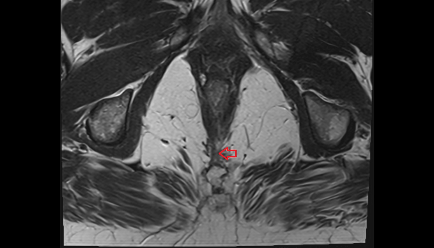 Anococcygeal body (anococcygeal ligament)  mri axial anatomy  image-img-00000-00000