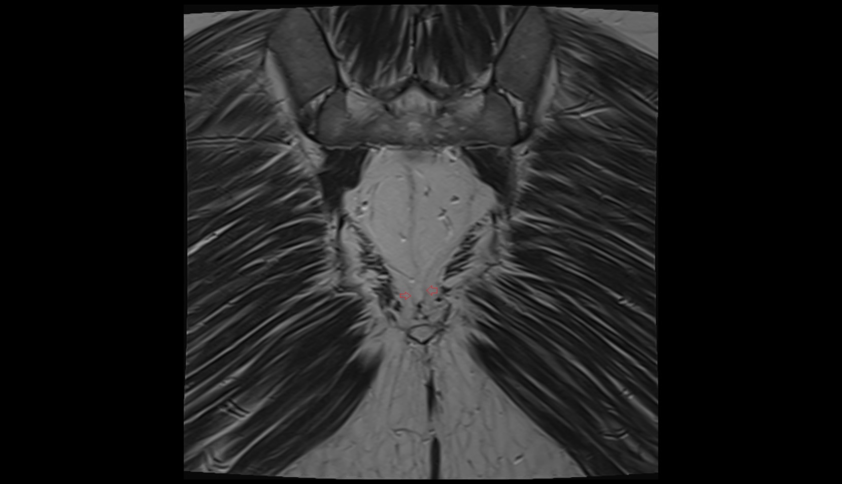 Anococcygeal nerve mri coronal image
