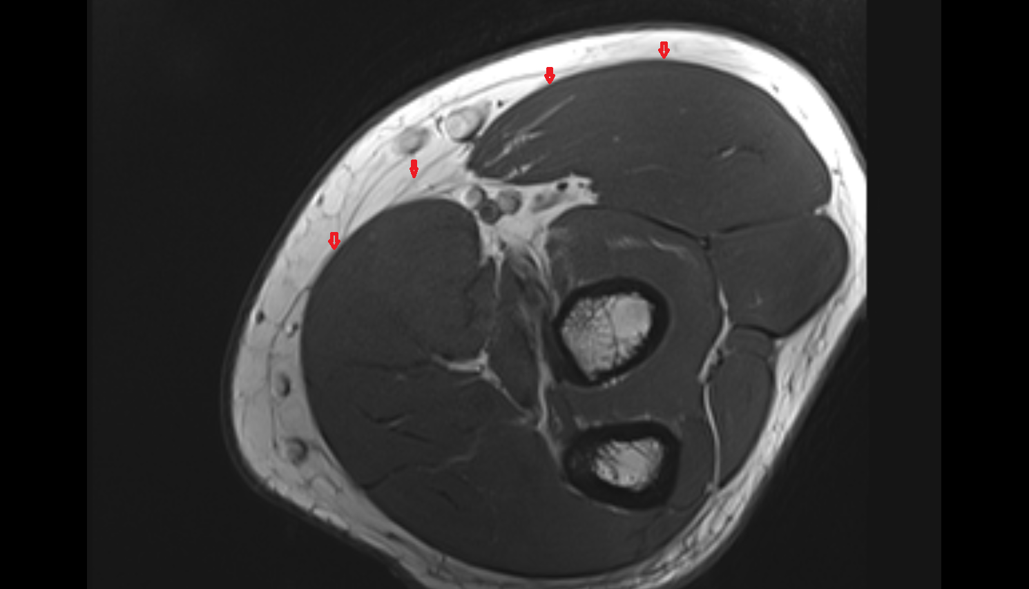 Antebrachial fascia axial cross sectional anatomy 3T MRI AI enhanced radiology image -img-00000-00000