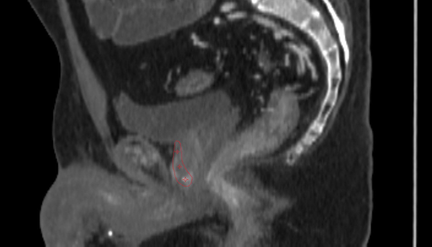 Anterior Fibromuscular Stroma  CT sagittal  anatomy  image-img-00000-00000_00001