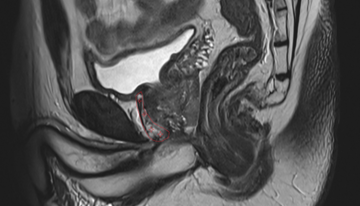 Anterior Fibromuscular Stroma  MRI sagittal  anatomy  image-img-00000-00000