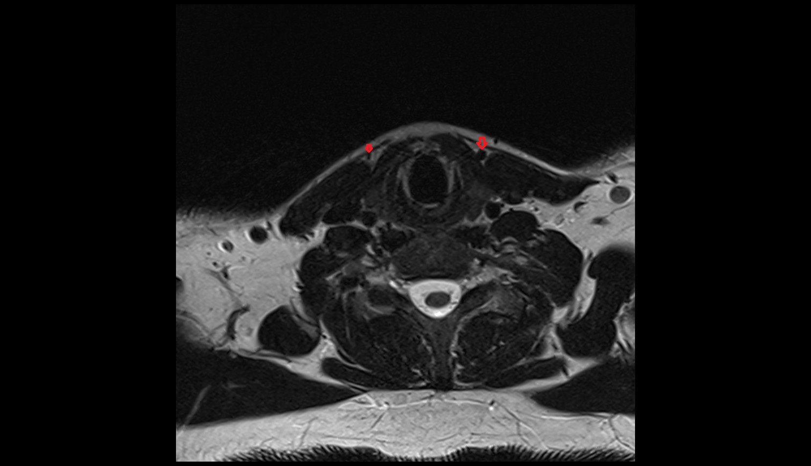 Anterior Jugular Vein