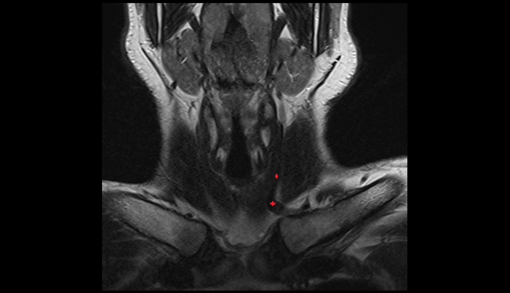 Anterior Jugular Vein coronal t2 image