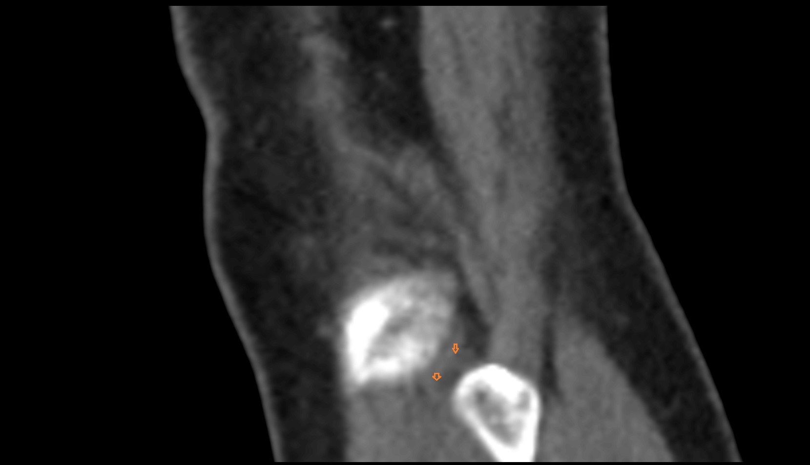 Anterior Ligament of Fibular Head CT SAG IMAGE