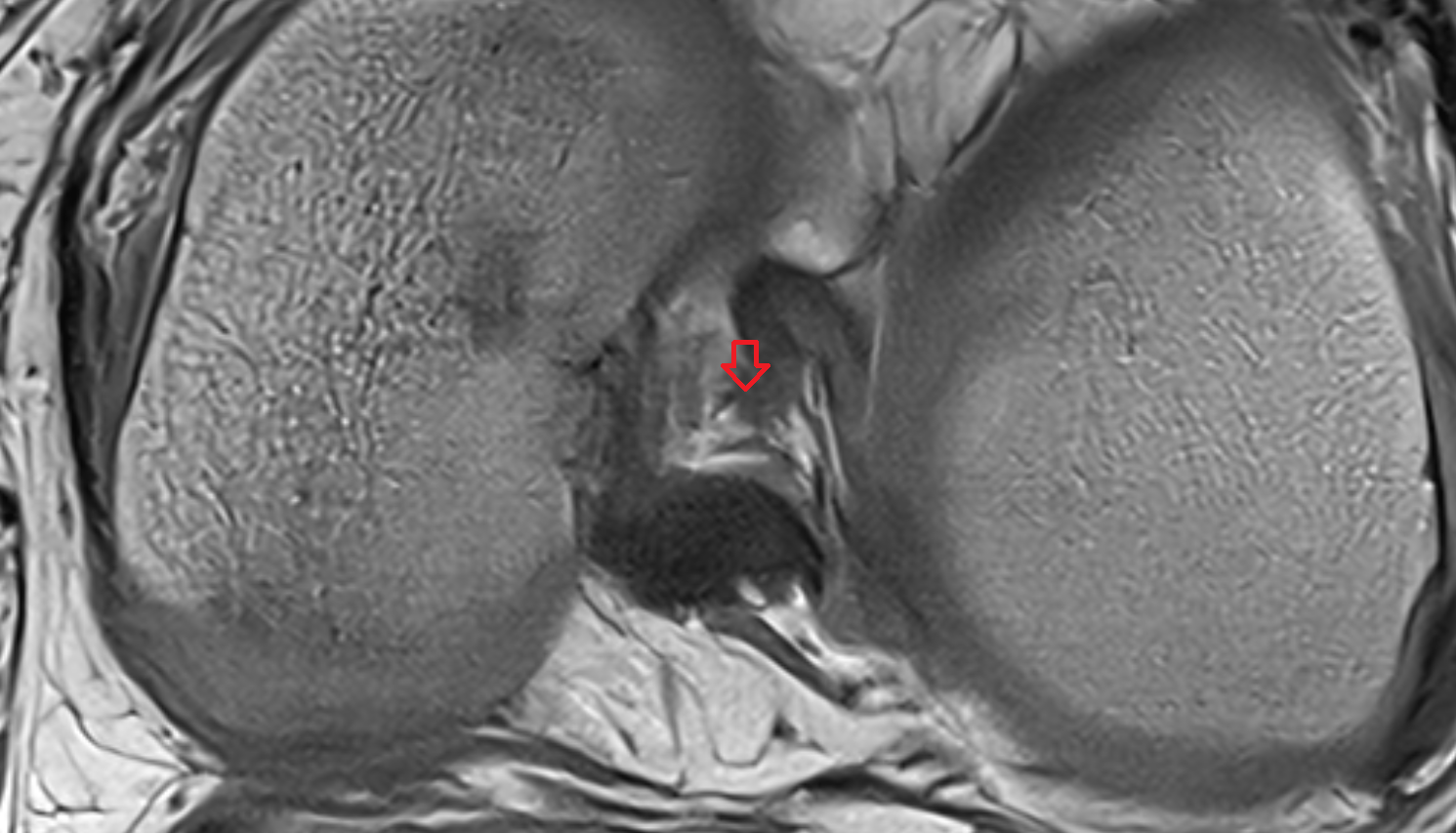 Anterior Meniscofemoral Ligament (Humphrey) axial cross sectional anatomy 3T MRI AI enhanced  radiology  anatomy image-img-00000-00000