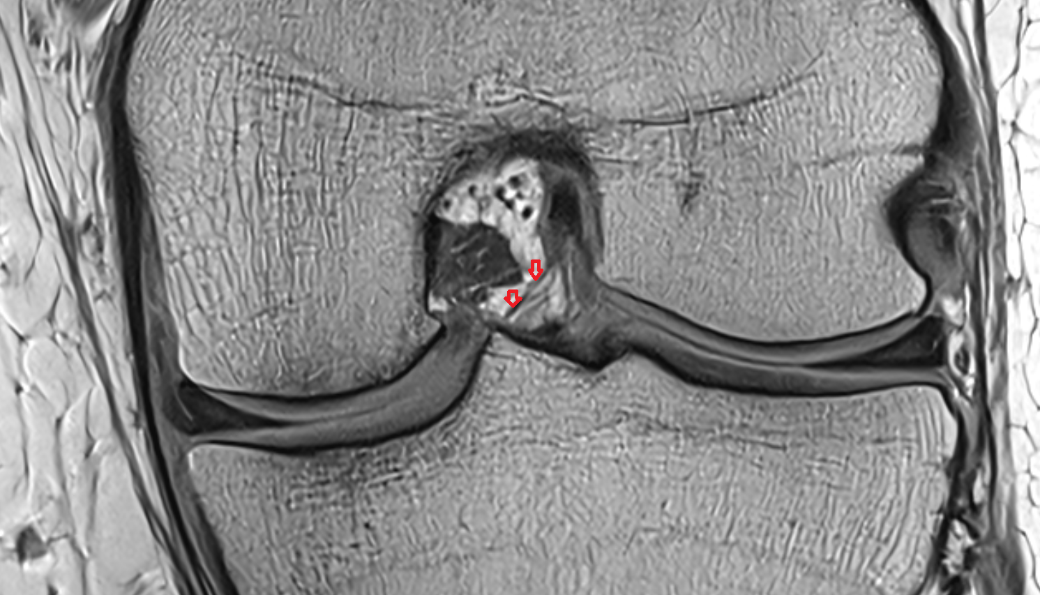 Anterior Meniscofemoral Ligament (Humphrey) coronal cross sectional anatomy 3T MRI AI enhanced  radiology  anatomy image-img-00000-00000