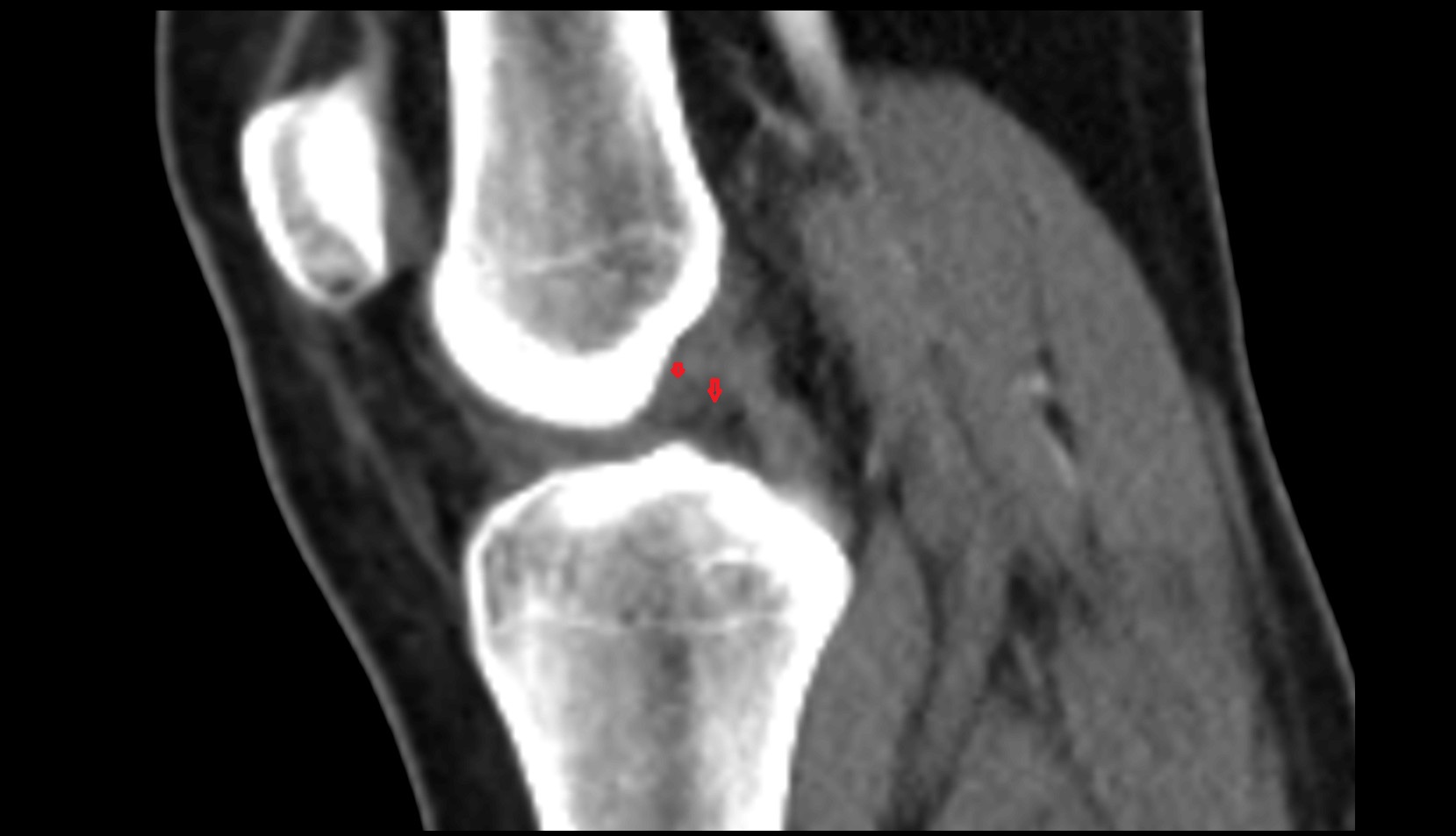 Anterior Meniscofemoral Ligament (Humphrey) ct image